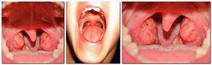 Стафилококус ауреус в гърлото симптоми, лечението с бактериофаг снимката на