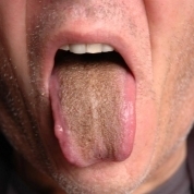 9 причини кафяви петна по езика