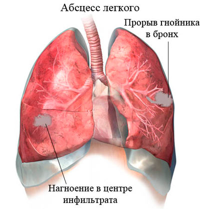 абсцес на белия дроб - за развитие, видове, усложнения