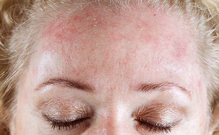 Алергии по челото симптоми, причини, лечение