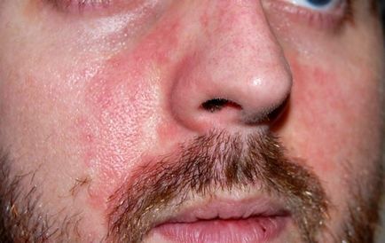 Алергия към бира - симптоми, лечение, снимки