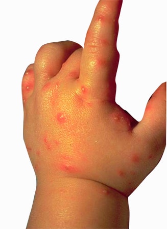 Алергия към ухапване от дървеници, отколкото опасно