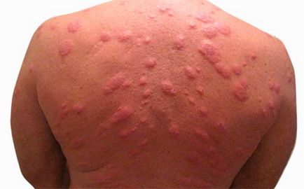 Алергия към ухапване от дървеници, отколкото опасно