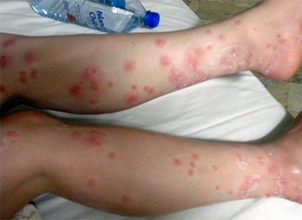 Дали това е алергия към ухапване от дървеници, опасно и как да се лекува