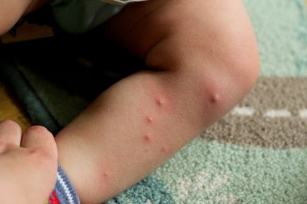 Алергия към ухапване от дървеници причини, симптоми, лечение