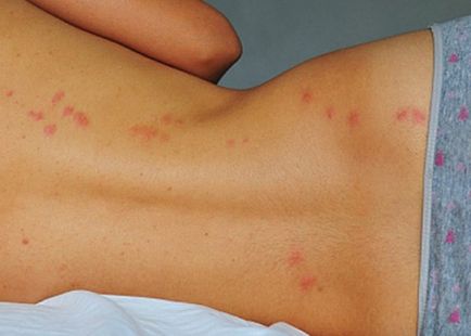 Алергия към ухапване от дървеници причини, симптоми, лечение