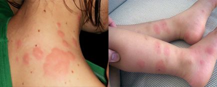 Алергия към ухапване от дървеници симптоми, лечение