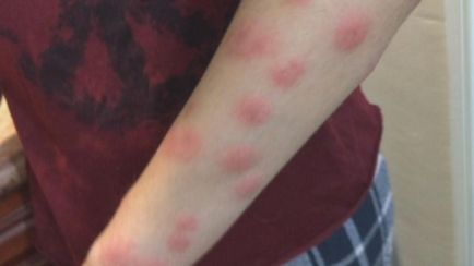 Алергия към ухапване от дървеници при деца и възрастни как да изглежда и как да се отнасяме