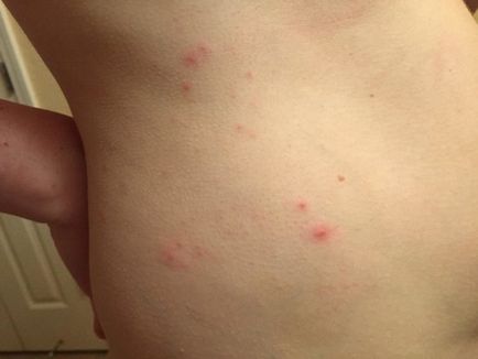 Алергия към ухапване от дървеници при деца и възрастни как да изглежда и как да се отнасяме