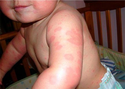 Алергия към ухапване от дървеници при деца и възрастни, симптоми и лечение