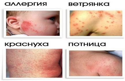 Алергия при кърмачета, как да се прояви, как да се идентифицират и лечение