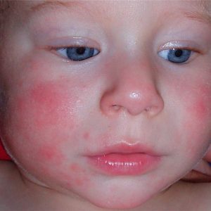Алергии в храните за алергични симптоми при деца под 1-годишна възраст и новороденото диагностика и