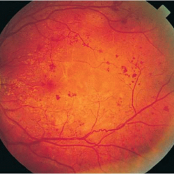 ретината, лечение ангиопатия око и традиционни народни средства