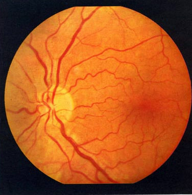 ретинална съдова ангиопатия причинява лечение на очите