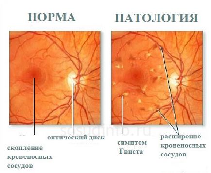 ретинална съдова ангиопатия причинява лечение на очите