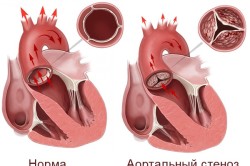 Аортните симптоми и лечение болест на сърцето