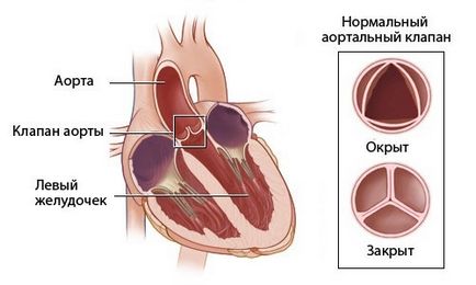 Аортните симптоми и лечение болест на сърцето
