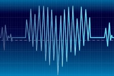 Аритмия ускорен пулс - лечение на сърцето