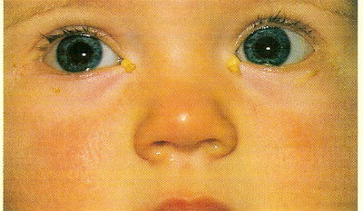 Офталмия при децата предизвиква, симптоми и лечение
