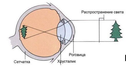 Описание на късогледство, лечение, причините, симптоми