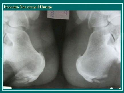 shintsa-halungda заболяване при деца като лечение, лечение на народната медицина, снимки