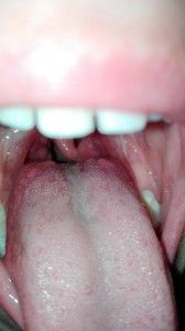 Боли езика при преглъщане причини възпаление