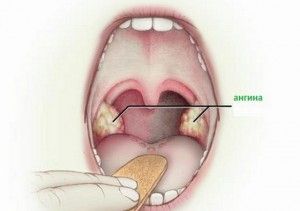 Боли езика при преглъщане причини възпаление