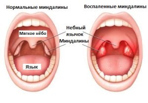 Боли езика при преглъщане, от една страна, и как да се отнасяме причините за болестта