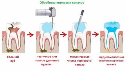 Зъбобол канали след почистването й лечение, запечатване и снимки