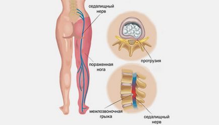 Болка в седалищния мускул наляво и надясно краката и кръста причини и лечение