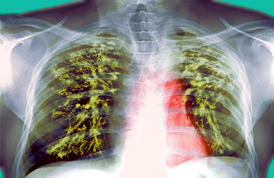 Бели дробове наранени никакви симптоми и какво да направите, причини и лечение