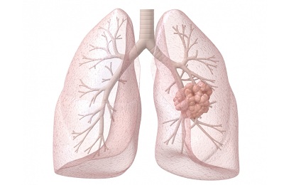 Бели дробове наранени никакви симптоми и какво да направите, причини и лечение