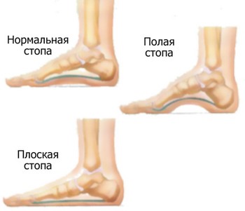 мускулите на краката Болки възможни причини, профилактика и лечение
