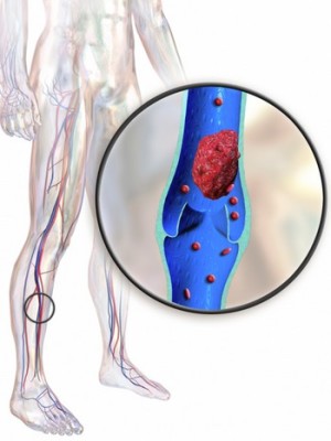 мускулите на краката Болки възможни причини, профилактика и лечение