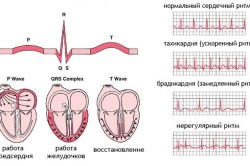 опасни тахикардия ефекти и усложнения