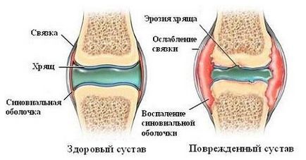 Какво става, ако много пращене ставите и които трябва да се вземат витамини