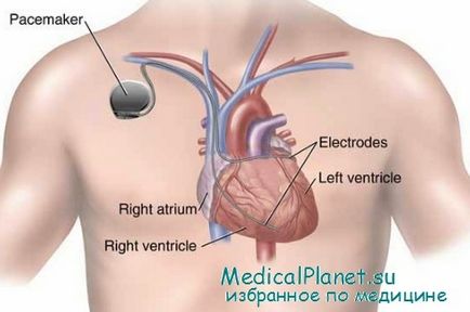 Какво е сърдечна ресинхронизираща терапия (МСТ) показания