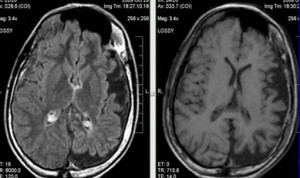 Какво е киста съдова плексус на мозъка при хора (Brain) Какво е киста съдова плексус на мозъка при хора