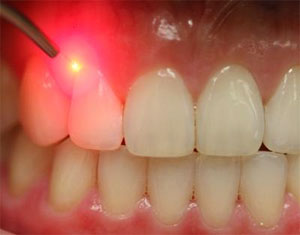 Какво е лазерна стоматология