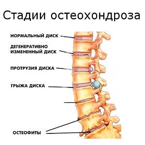 Какво е болка в гърба, отколкото е опасно и как да се лекува