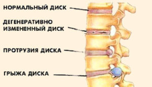Какво е най-изпъкнала част на гръбначния диск, неговите видове и етапи
