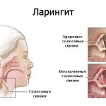 Ефективното лечение на обикновена настинка при малки деца народни средства