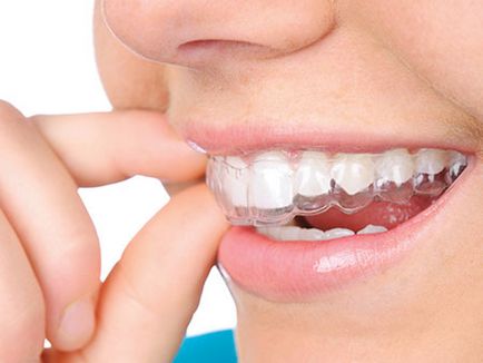 Aligner за изравняване описание зъби, снимки преди и след