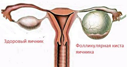 Endometrioid яйчниците лечение киста, симптоми, причини