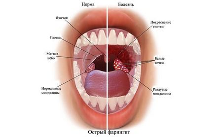 Фарингит при деца - симптоми и лечение, профилактика