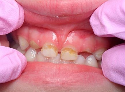 Флуорирането или сребърни бебешки зъби на детето си, че е по-добре да изберете