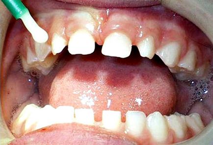 Флуорирането или сребърни бебешки зъби на детето си, че е по-добре да изберете