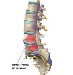 хемангиом на гръбначния стълб причинява симптомите, лечението