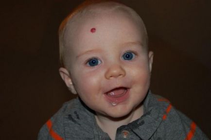 Хемангиоми при новородени (18 снимки) предизвиква и лечение, по главата и тила на гърдата, лицето,