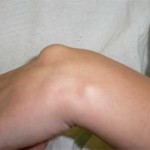 Hygroma за лечение на ръка и снимка на тумора